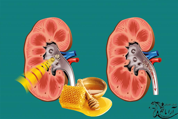 نقش عسل طبیعی در بیماری سنگ کلیه