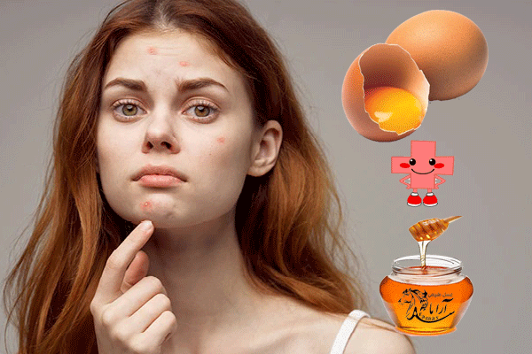 درمان جوش صورت با عسل و تخم مرغ