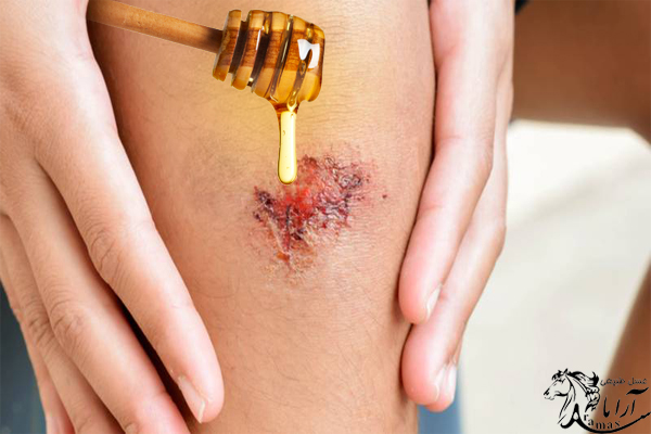 آیا واقعا عسل برای درمان زخم مفید است؟