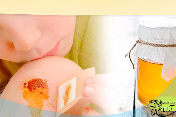 درمان انواع زخم‌ و سوختگی‌ ها با عسل