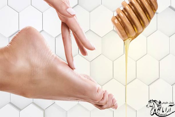 درمان زخم پای دیابتی با عسل