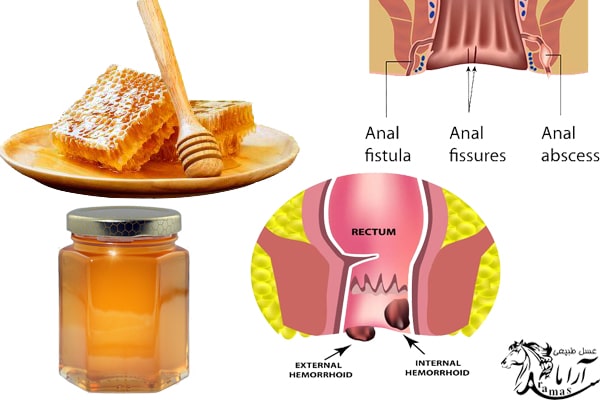 درمان بواسیر و شقاق با عسل طبیعی